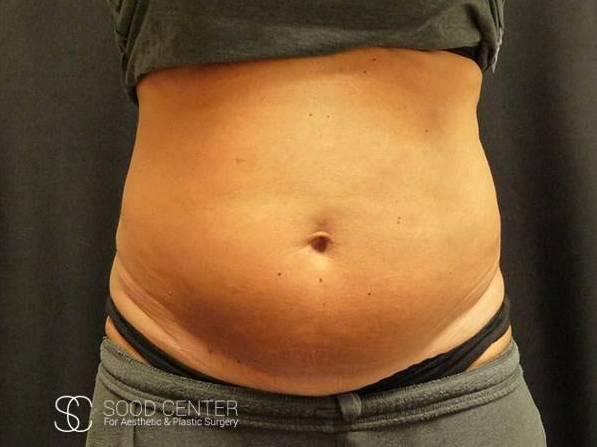 Coolsculpting Case10 Before