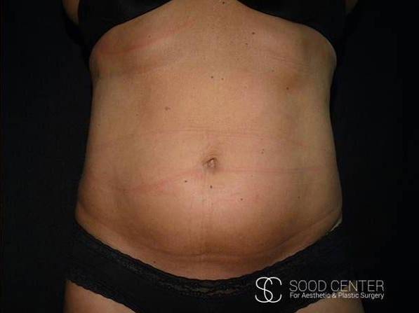 Coolsculpting Case10 After