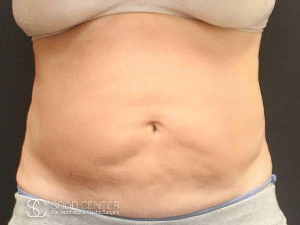 Coolsculpting Case11 Before