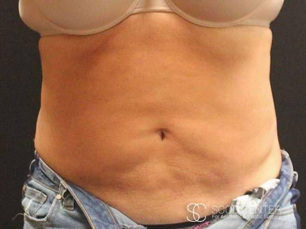 Coolsculpting Case11 After