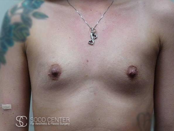 Breast Augmentation Case 02 Before