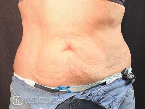 Coolsculpting Case12 Before