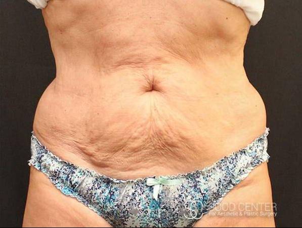 Coolsculpting Case12 After