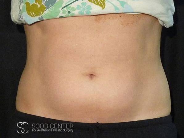 Coolsculpting Case13 Before