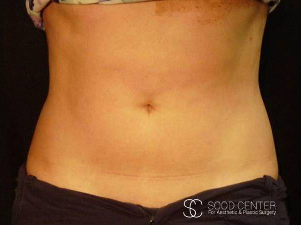 Coolsculpting Case13 After