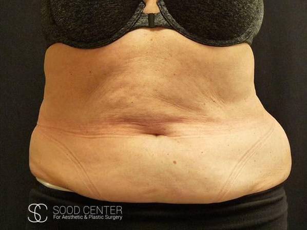 Coolsculpting Case14 Before