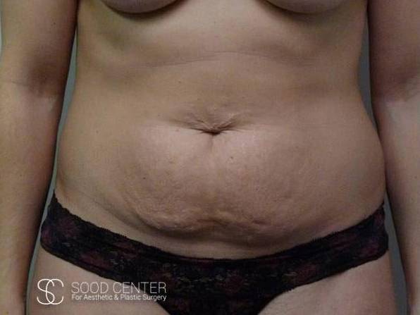 Coolsculpting Case15 Before