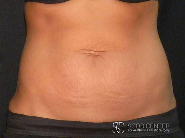 Coolsculpting Case15 After