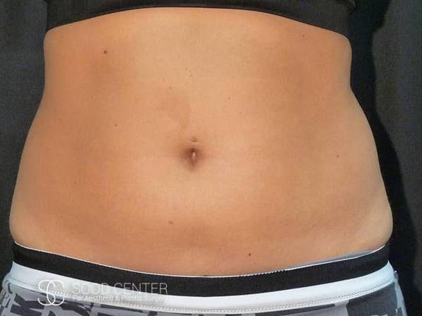 Coolsculpting Case16 Before
