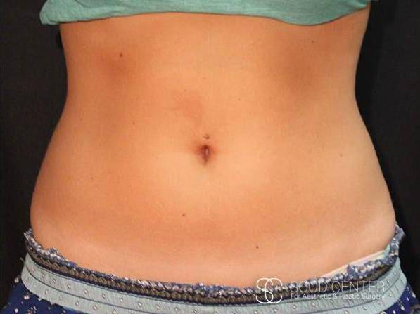 Coolsculpting Case16 After