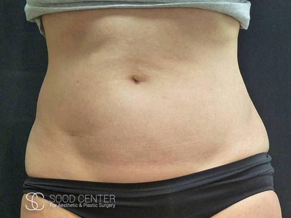 Coolsculpting Case17 Before