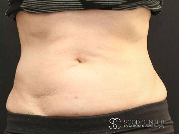 Coolsculpting Case17 After