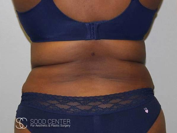 Coolsculpting Case18 Before