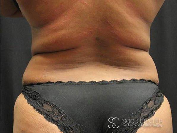 Coolsculpting Case18 After