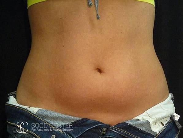 Coolsculpting Case19 Before