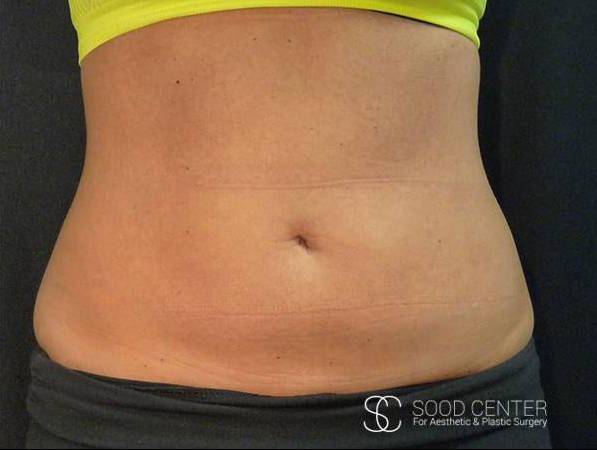 Coolsculpting Case19 After