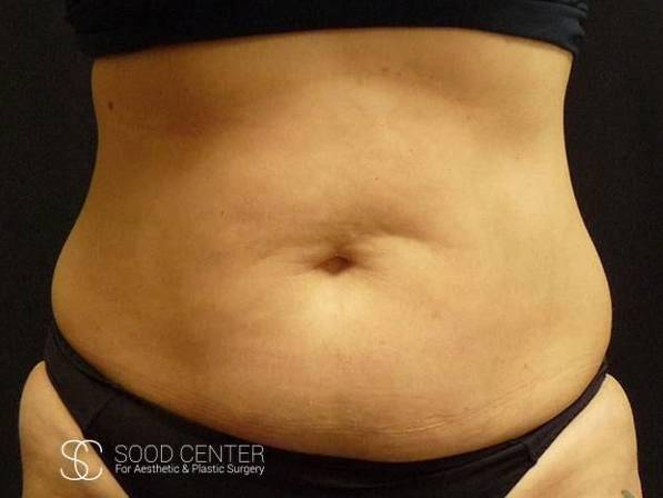 Coolsculpting Case20 Before