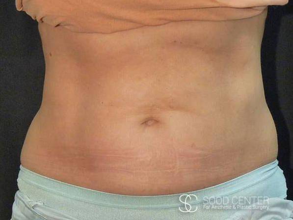 Coolsculpting Case20 After