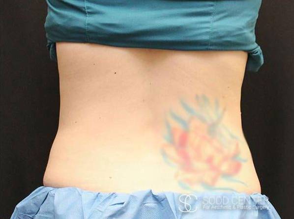 Coolsculpting Case21 After