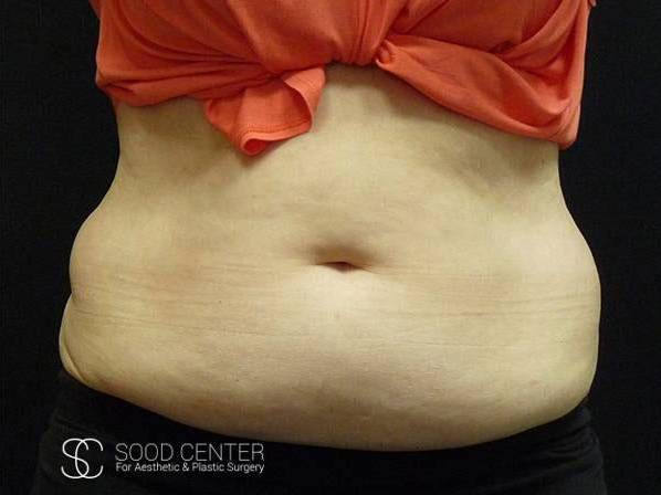Coolsculpting Case22 Before