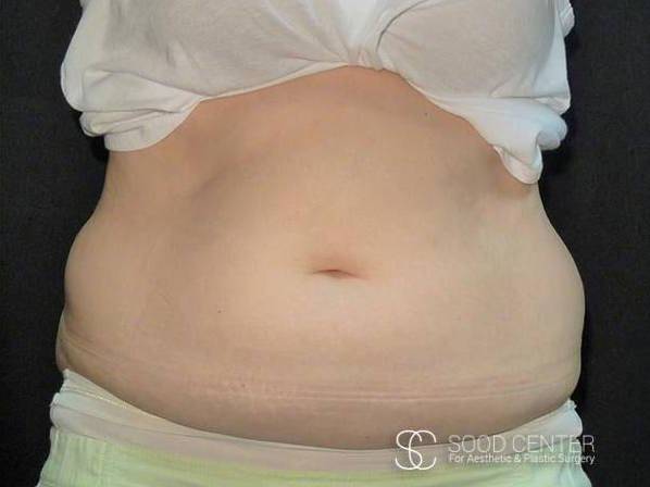 Coolsculpting Case22 After