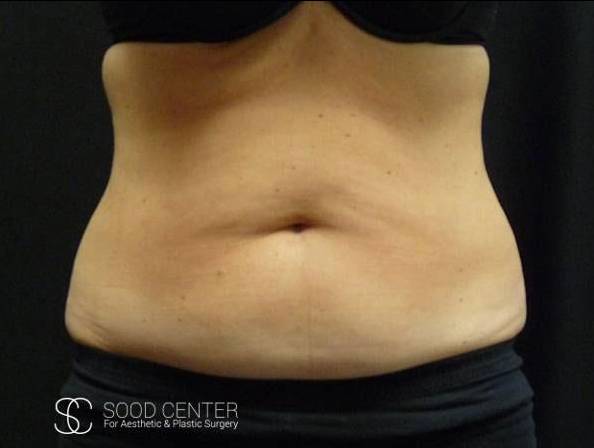 Coolsculpting Case23 Before