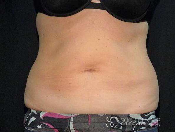 Coolsculpting Case23 After