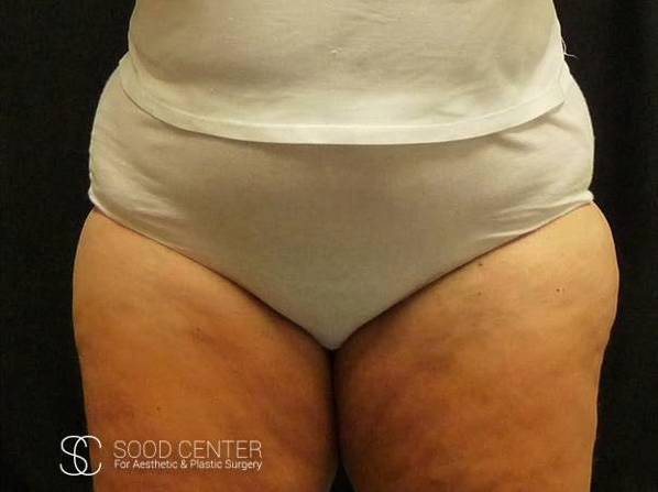 Coolsculpting Case25 Before