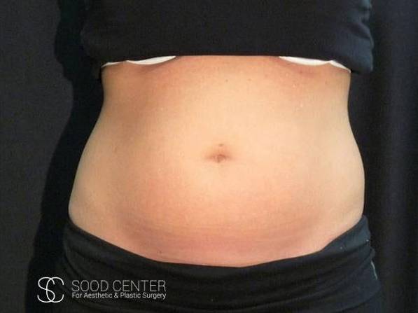Coolsculpting Case26 Before