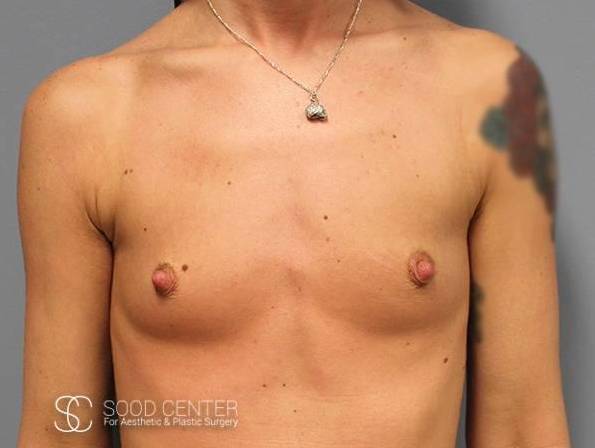 Breast Augmentation Case 03 Before