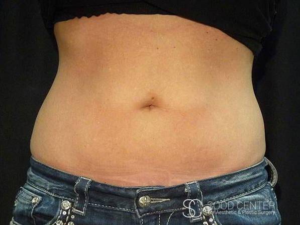 Coolsculpting Case26 After