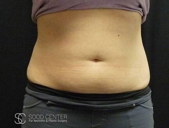 Coolsculpting Case27 Before