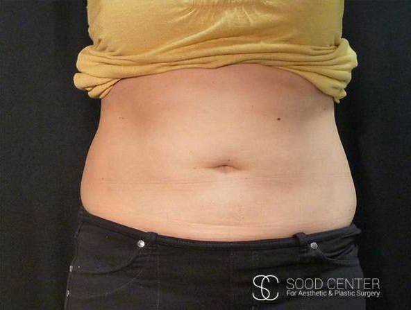 Coolsculpting Case27 After