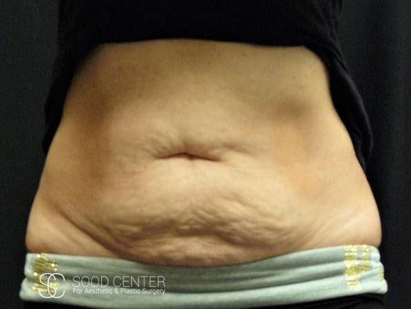 Coolsculpting Case28 Before