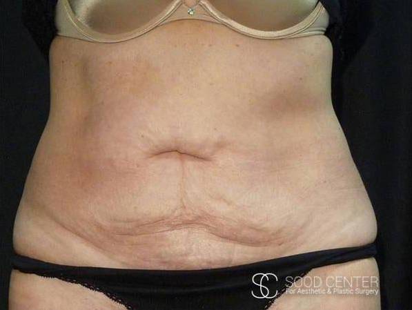 Coolsculpting Case28 After