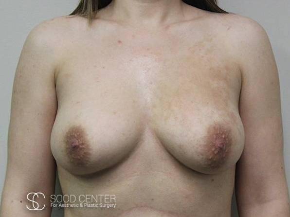 Breast Augmentation Case 04 Before