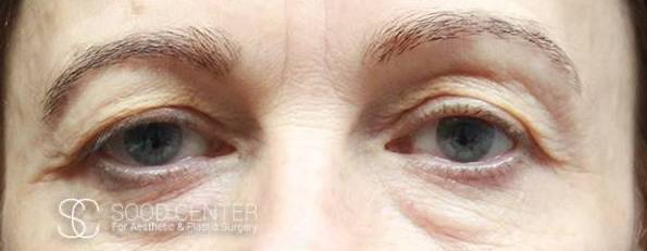 Blepharoplasty Before and After Pictures Before