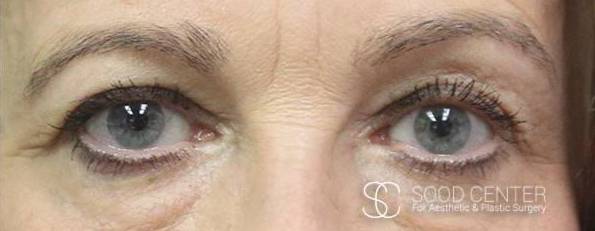 Blepharoplasty Before and After Pictures After