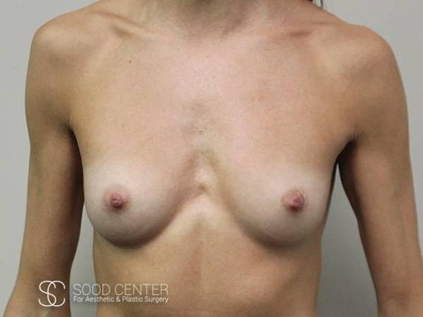 Breast Augmentation Case 05 Before