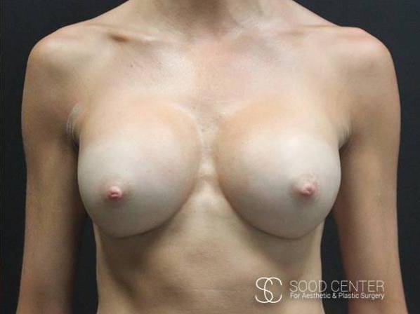 Breast Augmentation Case 05 After