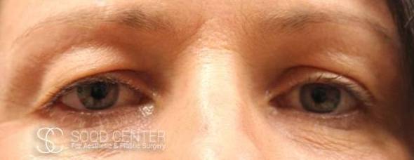 Blepharoplasty Case 02 Before