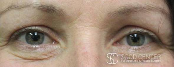 Blepharoplasty Case 02 After