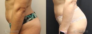 Brazilian Butt Lift Before and After Photos - Patient 1C