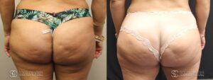 Brazilian Butt Lift Before and After Photos - Patient 1B
