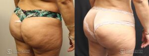 Brazilian Butt Lift Before and After Photos - Patient 1A