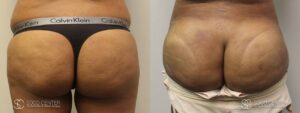 Brazilian Butt Lift Before and After Photos - Patient 2B