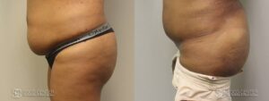 Brazilian Butt Lift Before and After Photos - Patient 2C