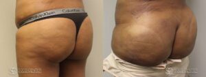 Brazilian Butt Lift Before and After Photos - Patient 2A