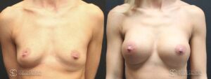 Breast Augmentation Before and After Photos - Patient 9A