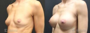 Breast Augmentation Before and After Photos - Patient 9B